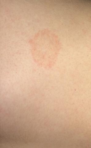 Roter Fleck Auf Bauch Was Kann Das Sein Gesundheit Korper Krankheit Roter Fleck Auf Bauch Was Kann Das Sein Gesundheit Korper Krankheit
