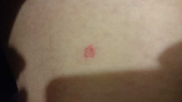 Hilfe Roter Fleck Auf Meinem Oberschenkel Weiss Jemand Was Das Ist Im Internet Steht Irgendwas Von Weissem Hautkrebs Flecken Hilfe Roter Fleck Auf Meinem Oberschenkel Weiss Jemand Was Das Ist Im Internet Steht Irgendwas Von Weissem Hautkrebs Flecken