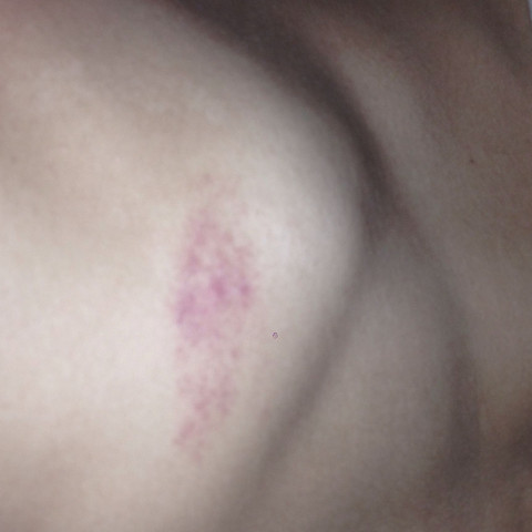 Hilfe Roter Fleck Flecken Orthomol Hilfe Roter Fleck Flecken Orthomol