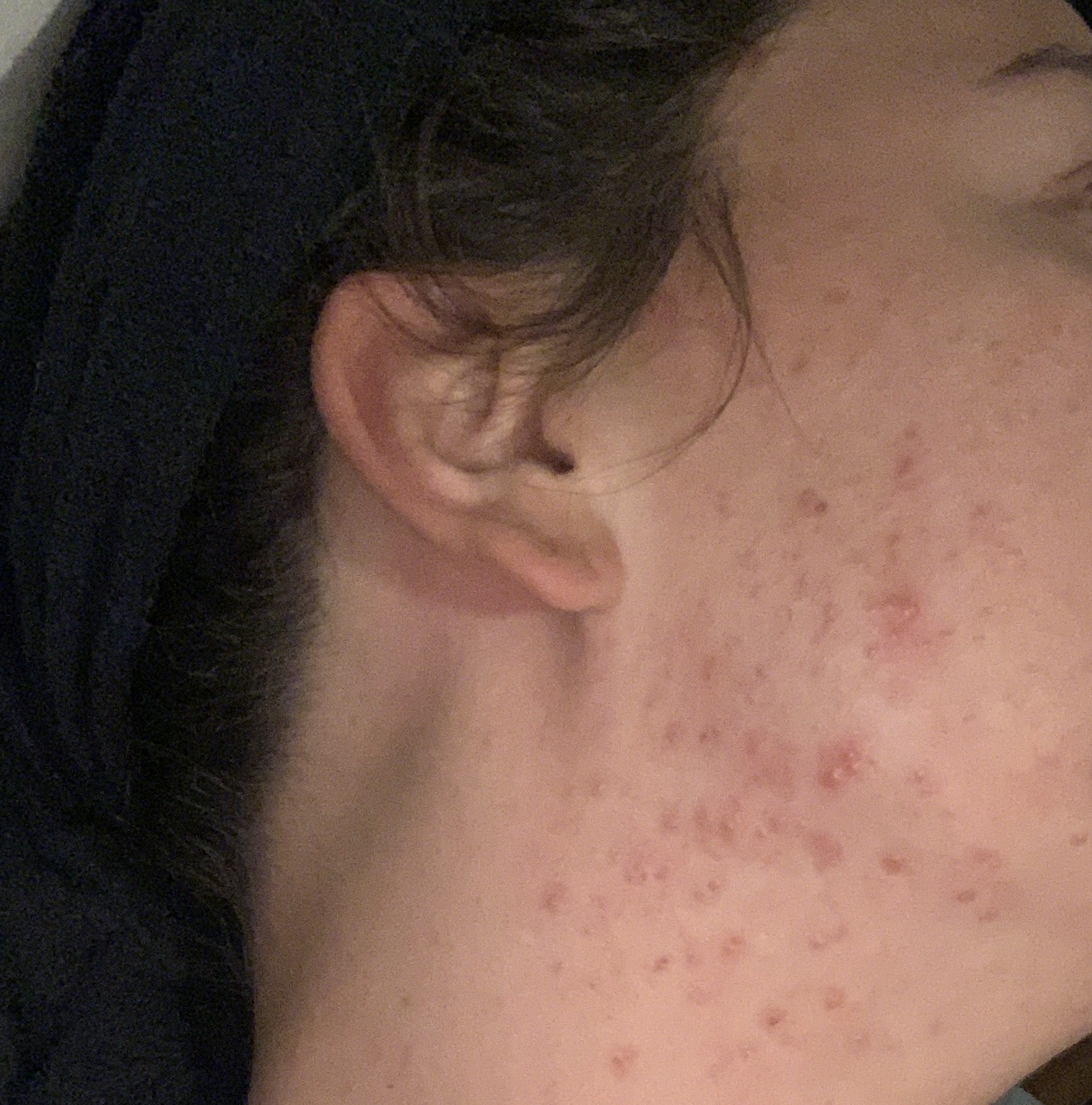 Mein Mittel Gegen Hautprobleme Ekzeme Dermatitis