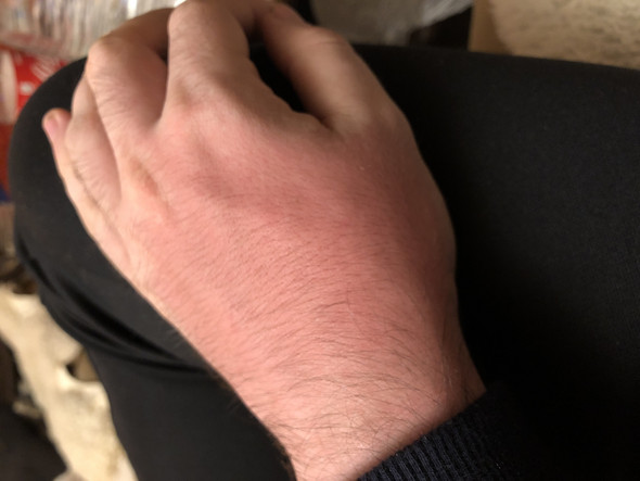 45++ Thrombose im arm bilder , Hilfe Thrombose in den händen? (Gesundheit und Medizin, Angst, Erkrankung)