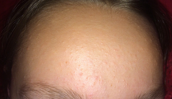 pickel auf der stirn im alter pickel auf der stirn im alter