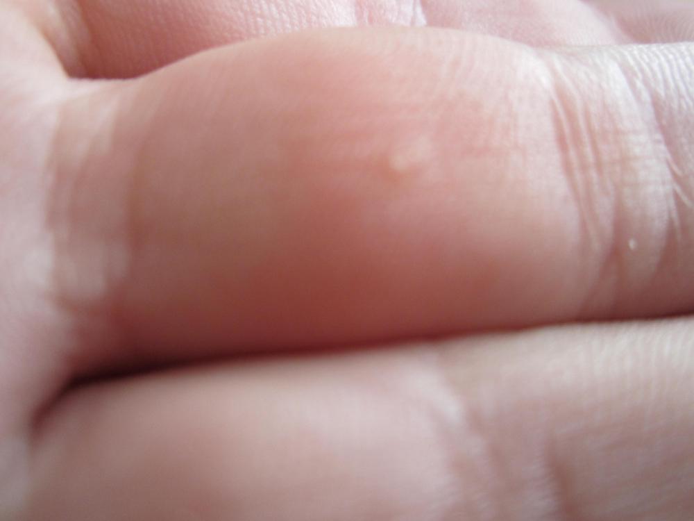 Hilfe Warze Hilfeee Haut Finger Warzen Hilfe Warze Hilfeee Haut Finger Warzen