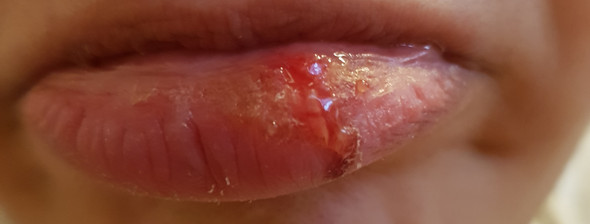 Hilfe Was Kann Das Sein Gesundheit Lippe Hilfe Was Kann Das Sein Gesundheit Lippe