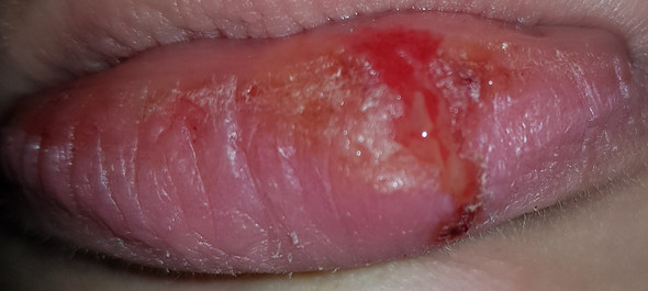 Hilfe Was Kann Das Sein Gesundheit Lippe Hilfe Was Kann Das Sein Gesundheit Lippe