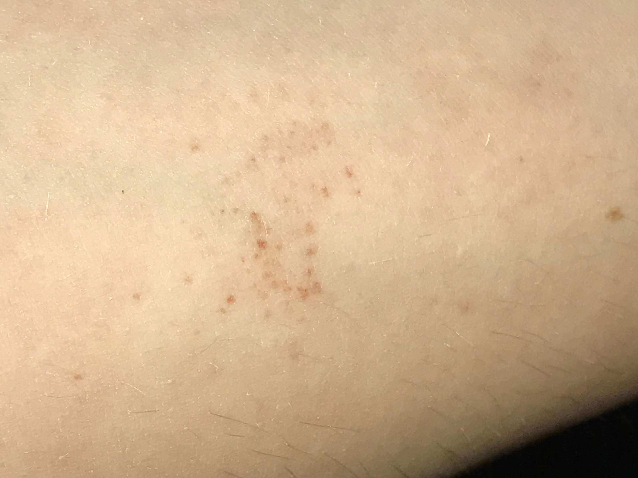 Hilfe was habe ich auf der Haut? (Gesundheit und Medizin, Leukämie, rote-punkte)