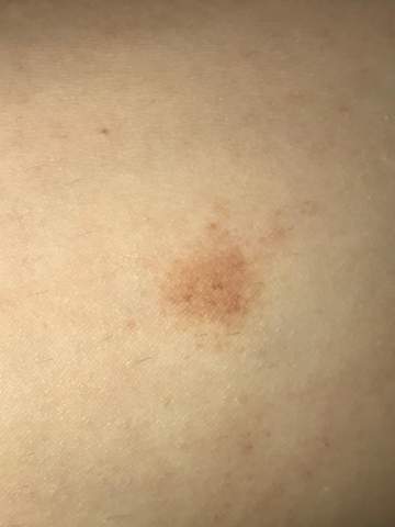 Hilfe was habe ich auf der Haut? (Gesundheit und Medizin, Leukämie