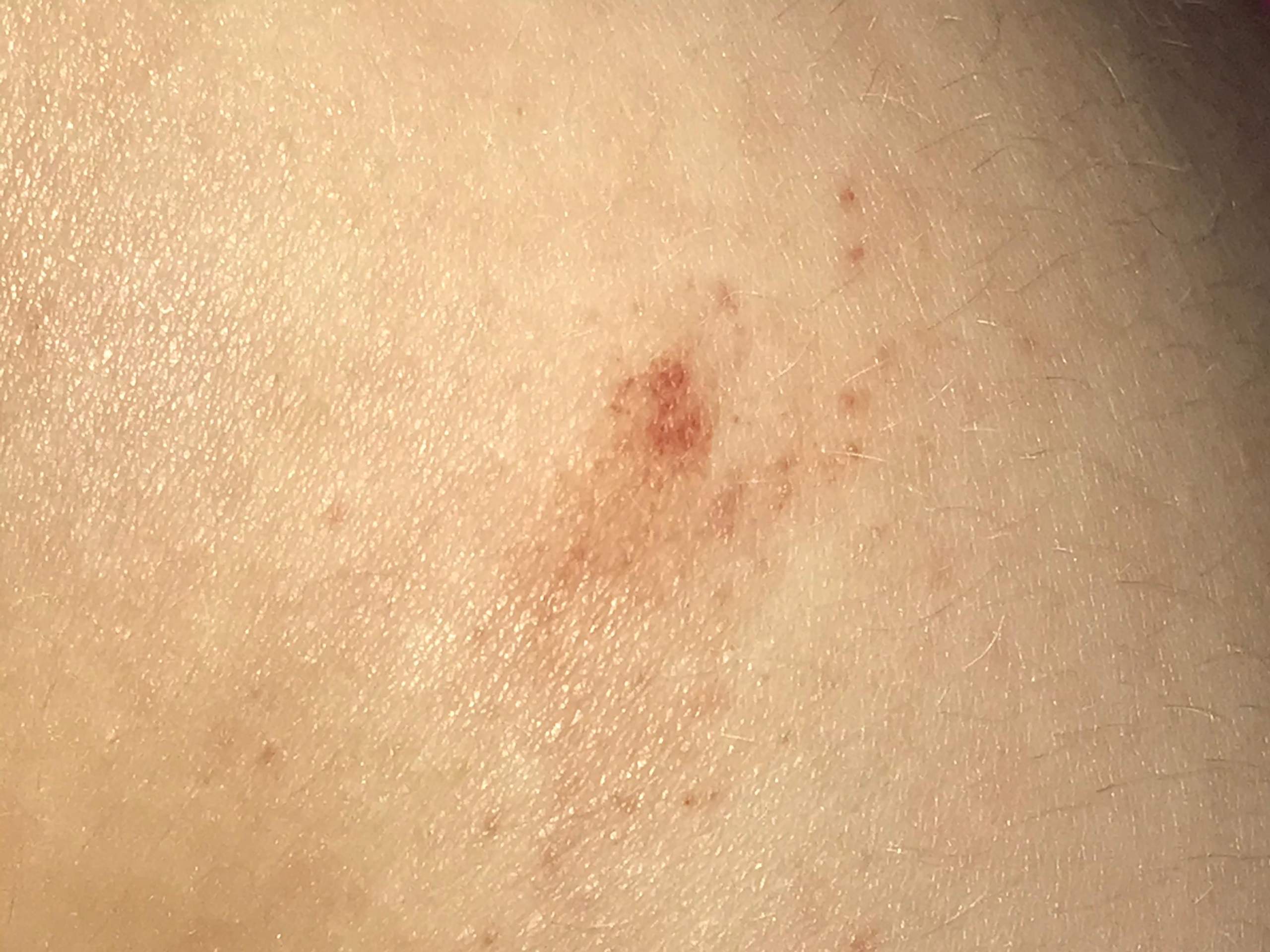 Leukämie Winzige Rote Punkte Auf Der Haut
