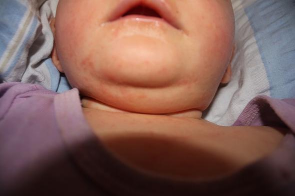 Hilfe Was Hat Mein Baby Fur Einen Ausschlag Krankheit Mutter Medikamente Hilfe Was Hat Mein Baby Fur Einen Ausschlag Krankheit Mutter Medikamente