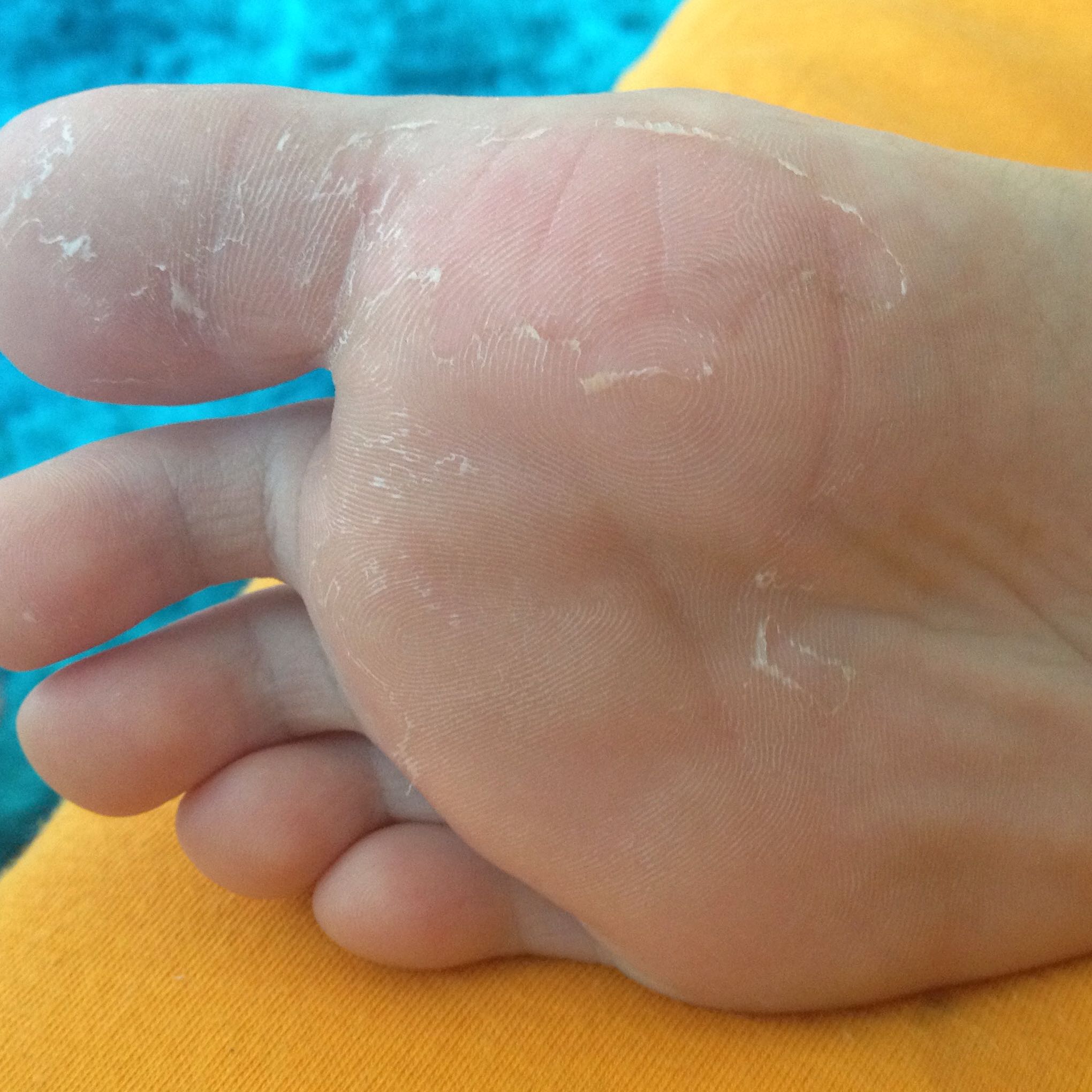 Blinder Glaube Sichern Verschiedene Waren wenn sich die haut an den füßen schält Evolution Blinder Glaube Sichern Verschiedene Waren wenn sich die haut an den füßen schält Evolution