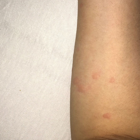 Arme - (Gesundheit und Medizin, Allergie, Hautausschlag)