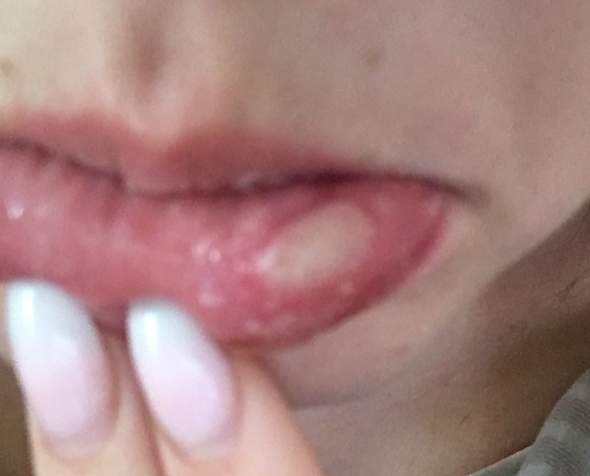 Hilfe Was Ist Das An Meiner Lippe Gesundheit Und Medizin Gesundheit Arzt Hilfe Was Ist Das An Meiner Lippe Gesundheit Und Medizin Gesundheit Arzt