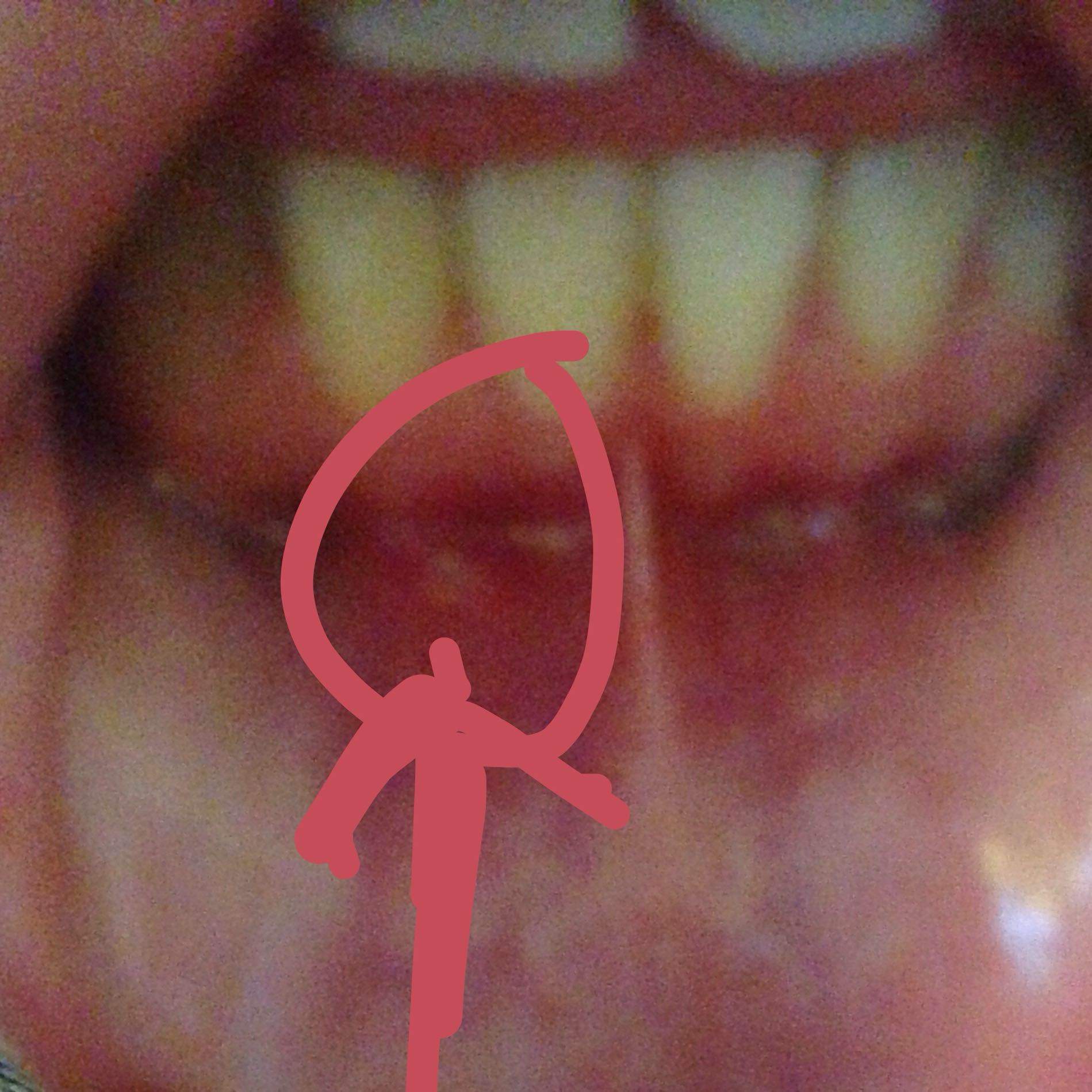 Hilfe Was Ist Das Ein Fistel Zahnarzt Hilfe Was Ist Das Ein Fistel Zahnarzt