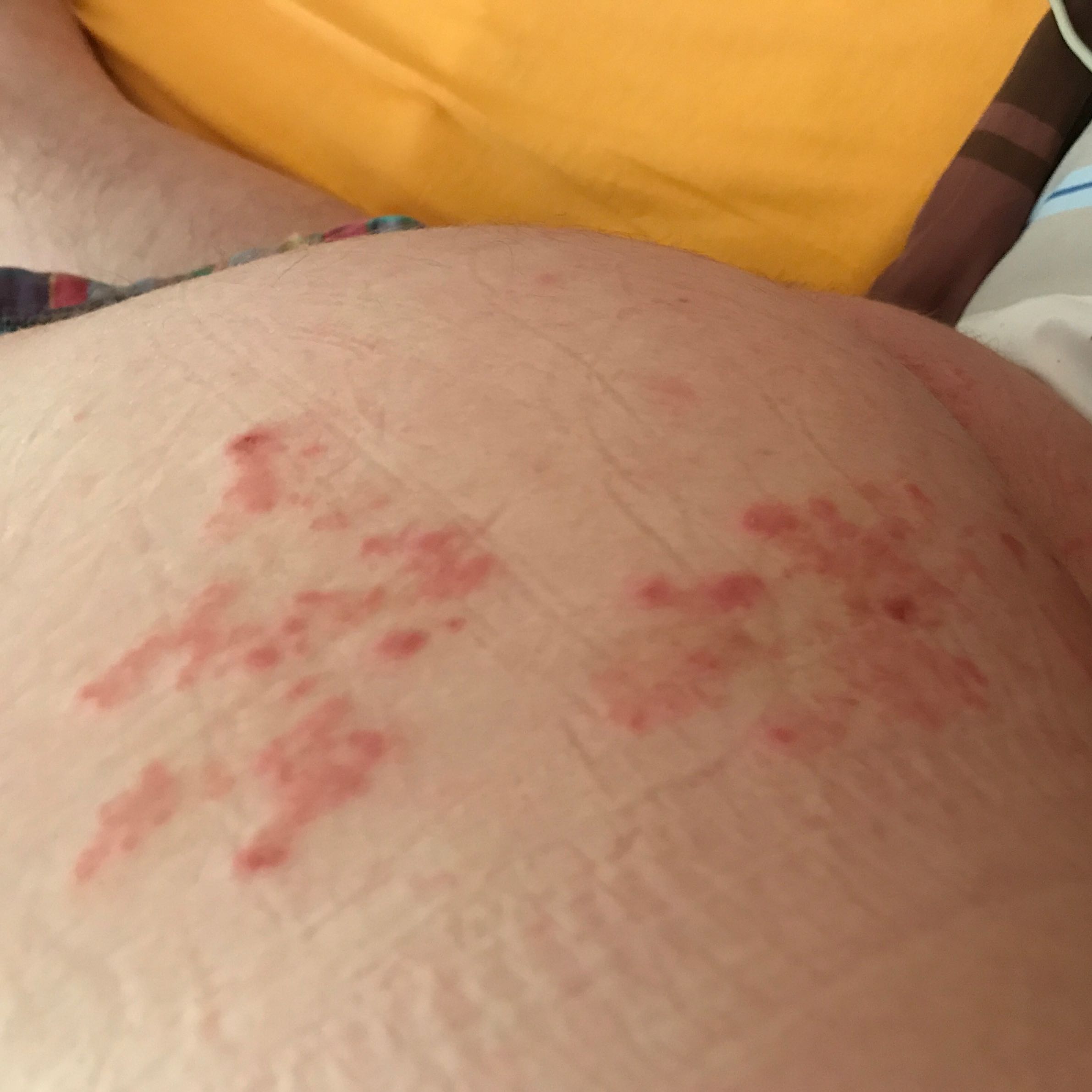Hilfe was ist das für ein Ausschlag, für eine Hautkrankheit? (Allergie