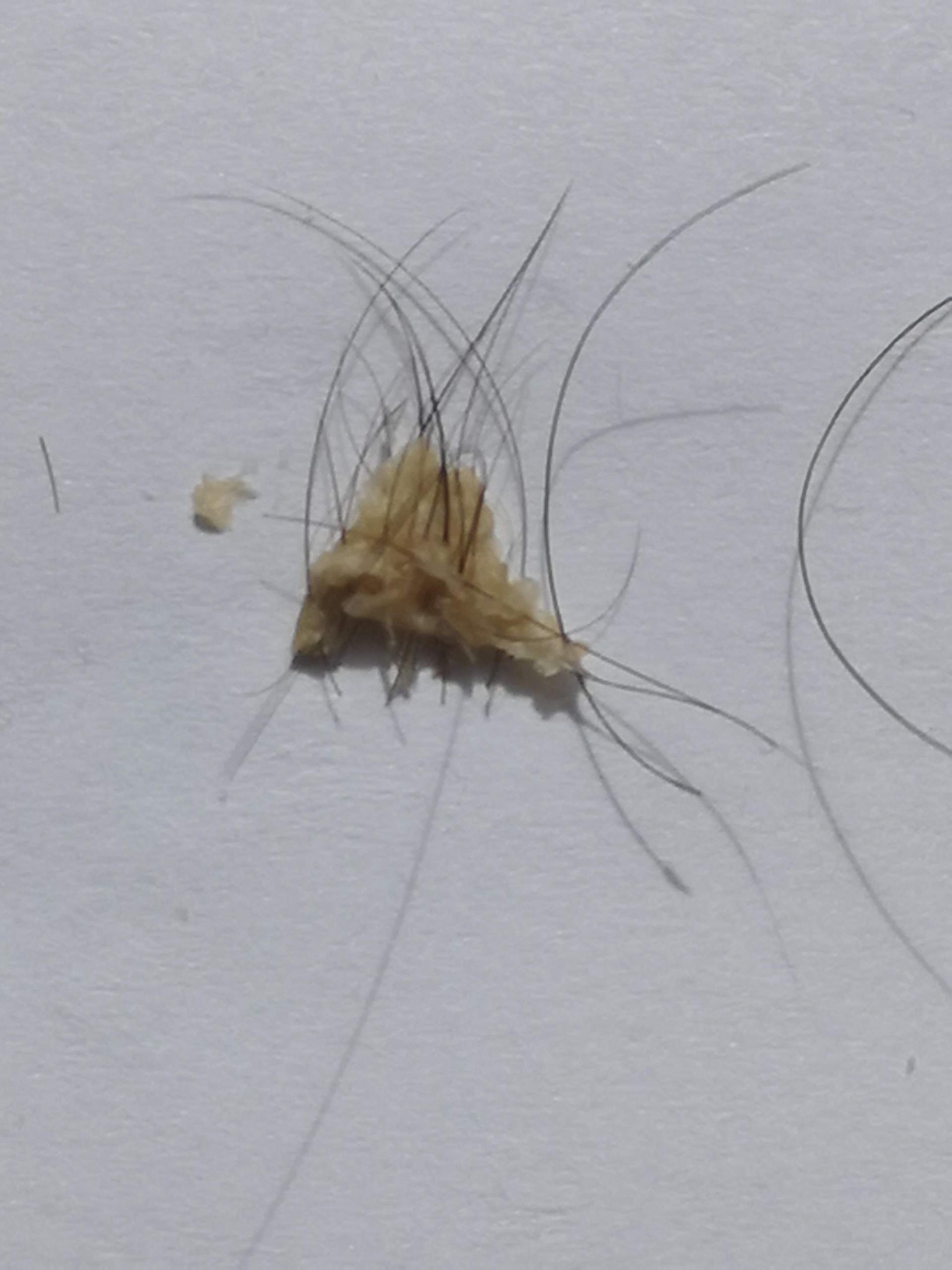 Hilfe, was ist das für eine art Schuppenbildung auf meiner Kopfhaut das die Haarwurzeln angreift ...