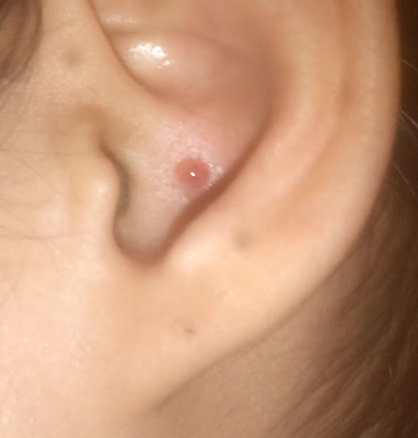 Hilfe Was Ist Das In Meinem Ohr Pickel