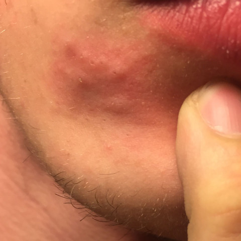 Das Teil - (Haut, Pickel, Dermatologie)