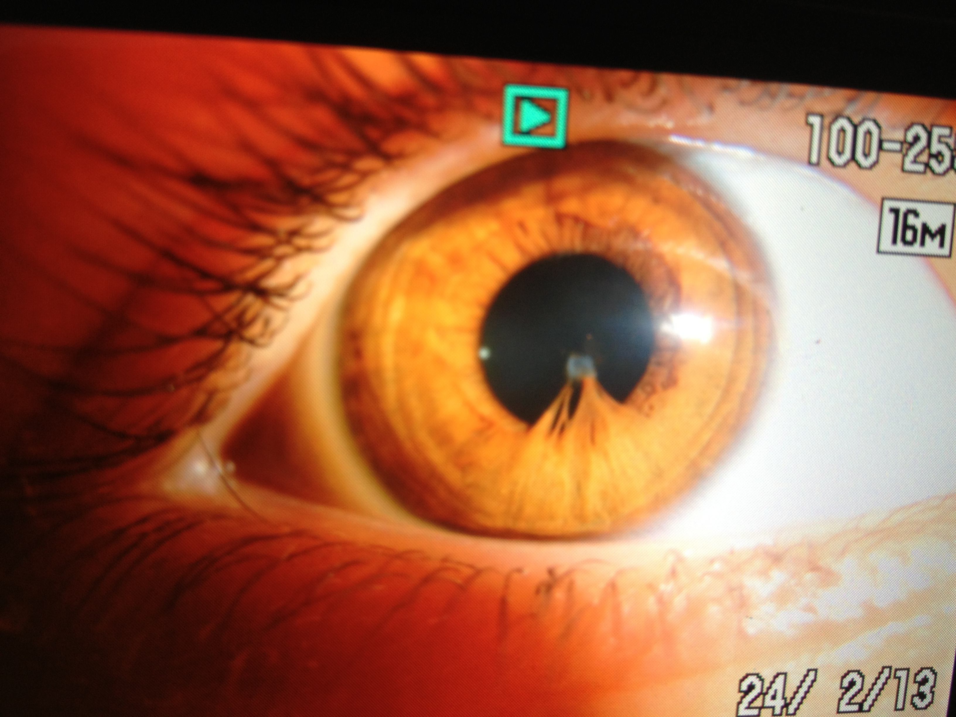 Hilfe Was Ist Mit Meinen Augen Los Arzt Hilfe Was Ist Mit Meinen Augen Los Arzt