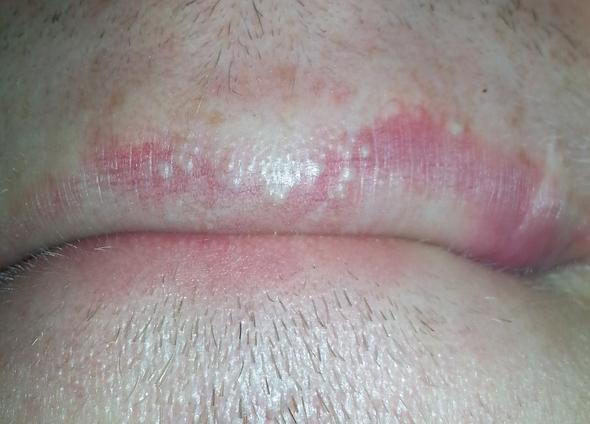 das is es - (Medizin, Pickel, Lippe)