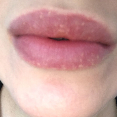 Hilfe Was Sind Das Fur Blaschen Auf Den Lippen Und An Dem Arm Gesundheit Und Medizin Gesundheit Korper Hilfe Was Sind Das Fur Blaschen Auf Den Lippen Und An Dem Arm Gesundheit Und Medizin Gesundheit Korper