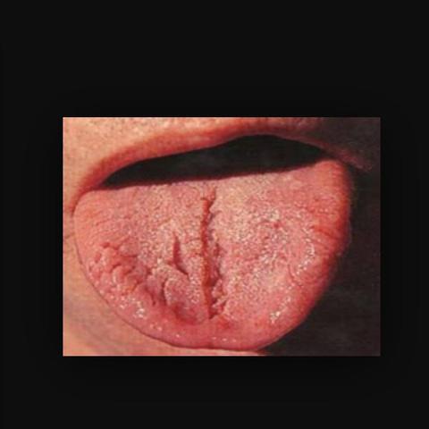 Hilfe Weiss Jemand Was Das Sein Konnte Allergie Zunge Loch Hilfe Weiss Jemand Was Das Sein Konnte Allergie Zunge Loch