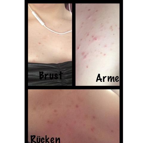 Haut
Pickel
Akne
Narben
Körper - (Körper, Arzt, Haut)