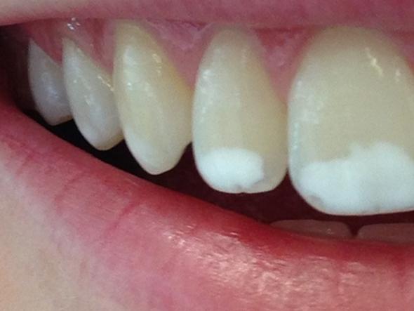 Weißer fleck - (Zähne, weißer Fleck, zahnverfärbung) .