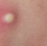 Das ist das - (Pickel, Lippe)