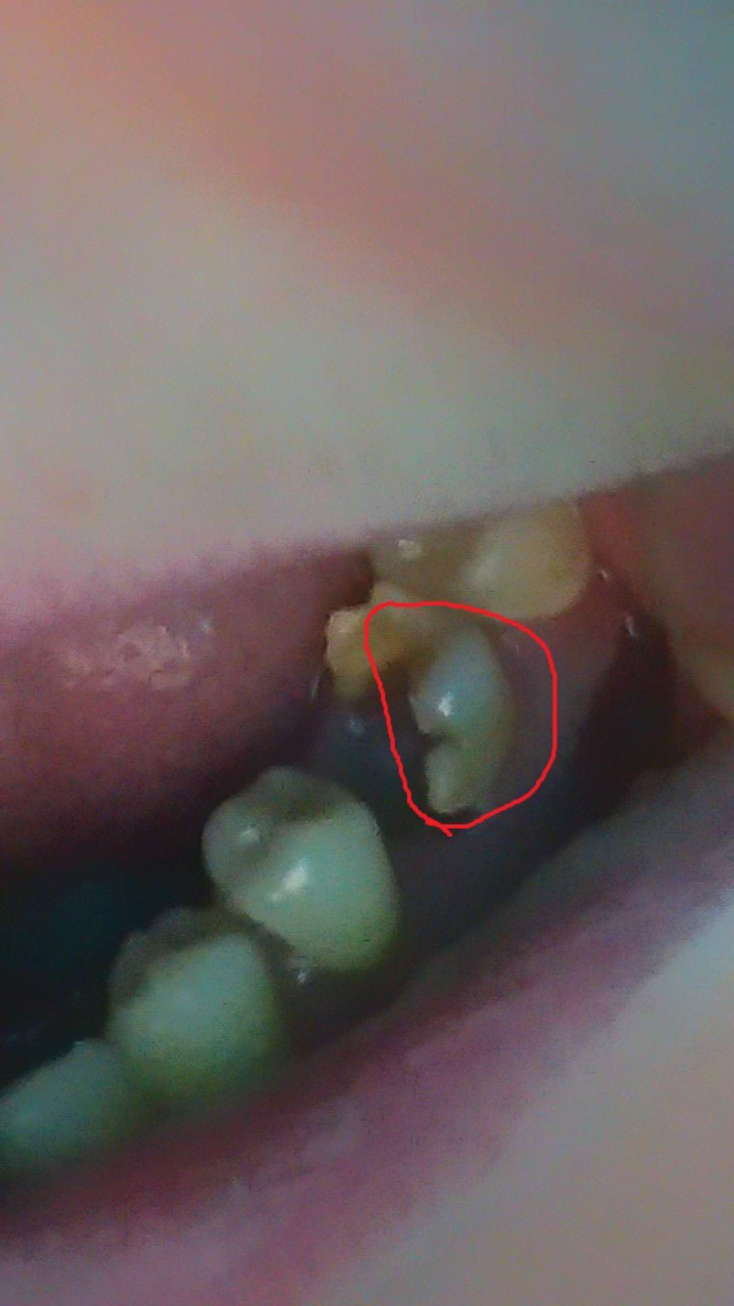 Halb abgebrochen zahn ω Zahn