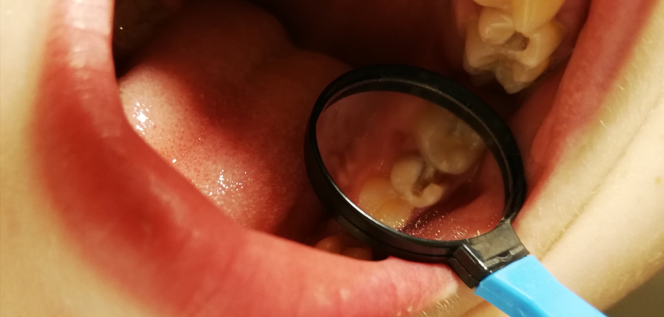 Hilfe Zahn Abgebrochen Ist Er Noch Zu Retten Gesundheit Zahne