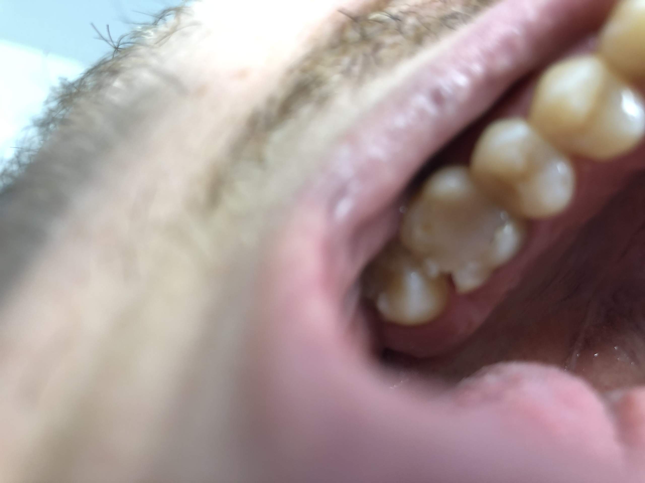 Backenzahn abgebrochen stück Abgebrochener Zahn