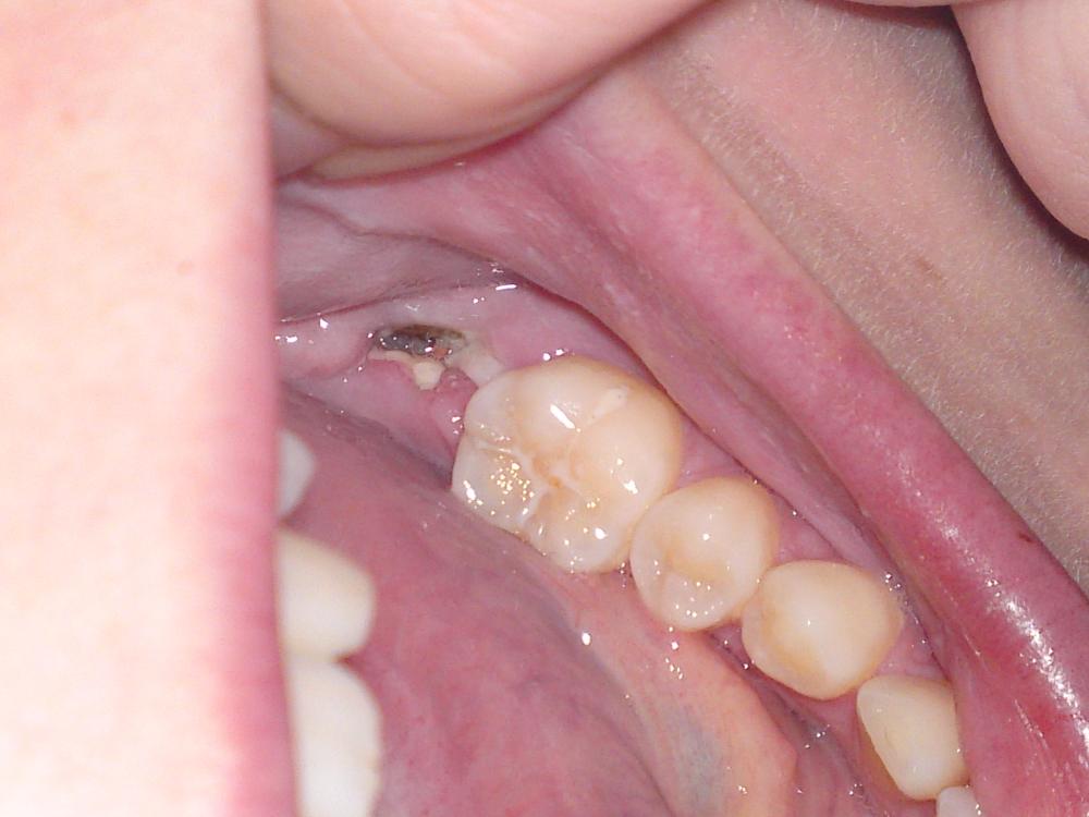 39+ Wundheilung nach zahnextraktion bilder , Hilfe Zahn gezogen Wunde verfärbt. (Medizin, Zahnarzt, Zahnmedizin)