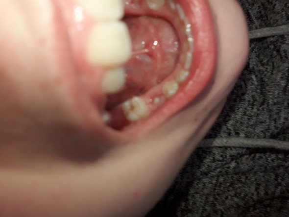 Hilfe Zahn Loch? (Gesundheit und Medizin, Zähne, Umfrage)