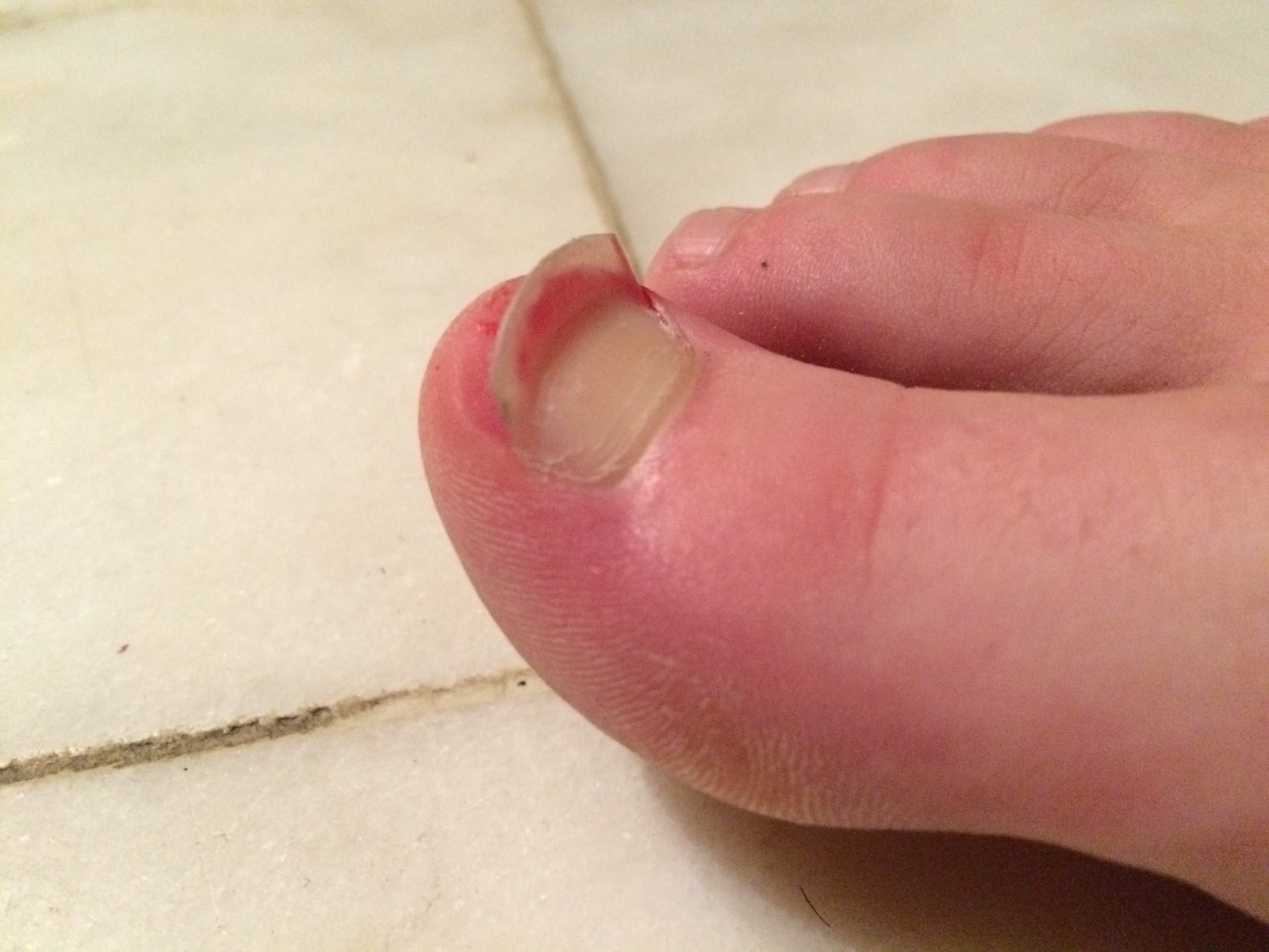 HILFE zehnagel steht senkrecht ab, was tun? vorsicht, fotos? (Zeh, Zehennagel) HILFE zehnagel steht senkrecht ab, was tun? vorsicht, fotos? (Zeh, Zehennagel)