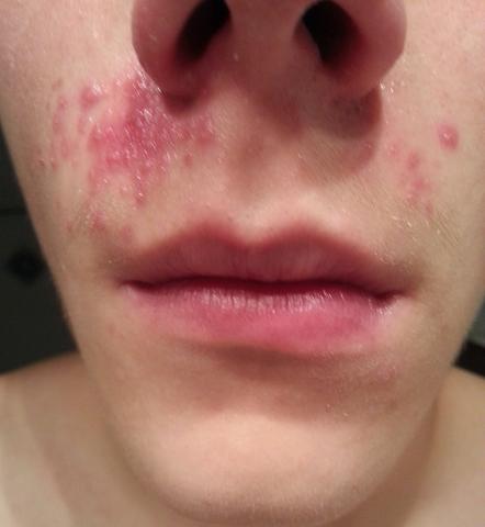 Hilfe Zu Ausschlag In Gesicht Krankheit Haut Allergie