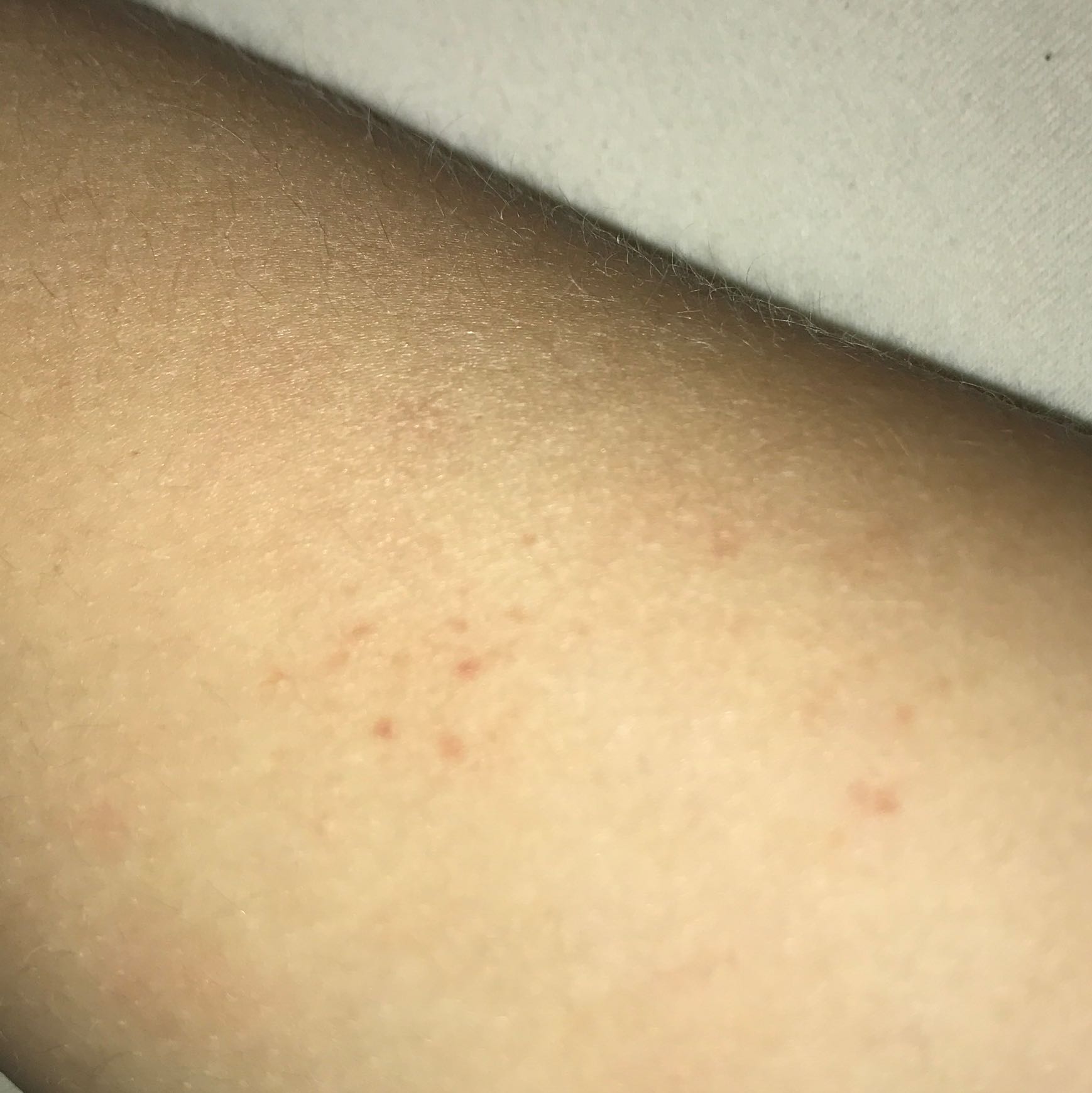 Hilfee ich habe heute am arm bemerkt das ich so rote kleine flecken Hilfee ich habe heute am arm bemerkt das ich so rote kleine flecken