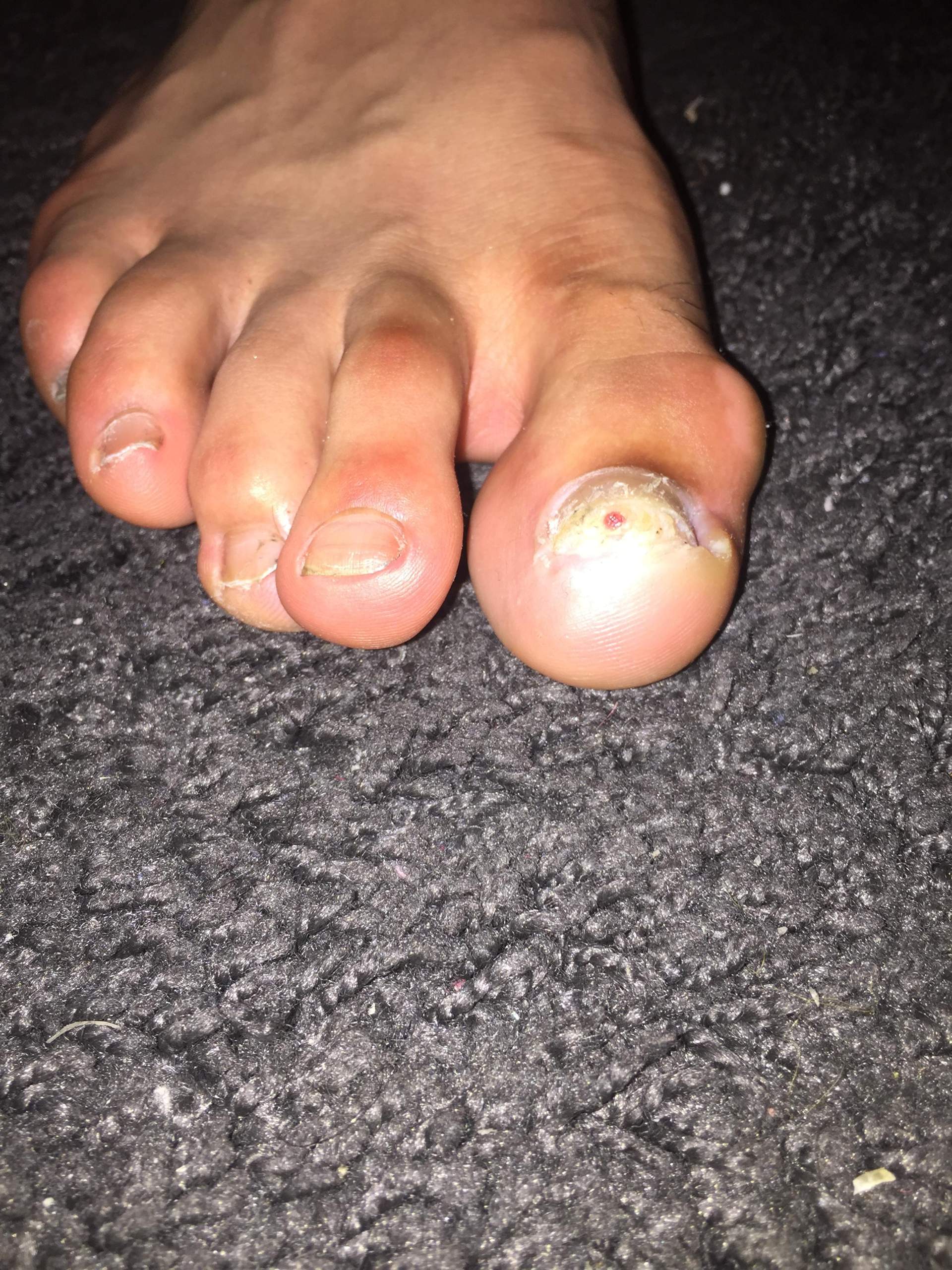 Hilfee !Hilfee! ist das Nagelpilz? (Gesundheit und Medizin)