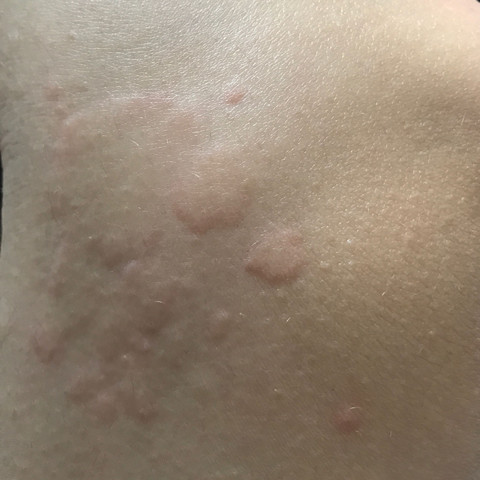 Hilfee Juckende Stiche Uberall Am Korper Stich Parasiten Hilfee Juckende Stiche Uberall Am Korper Stich Parasiten