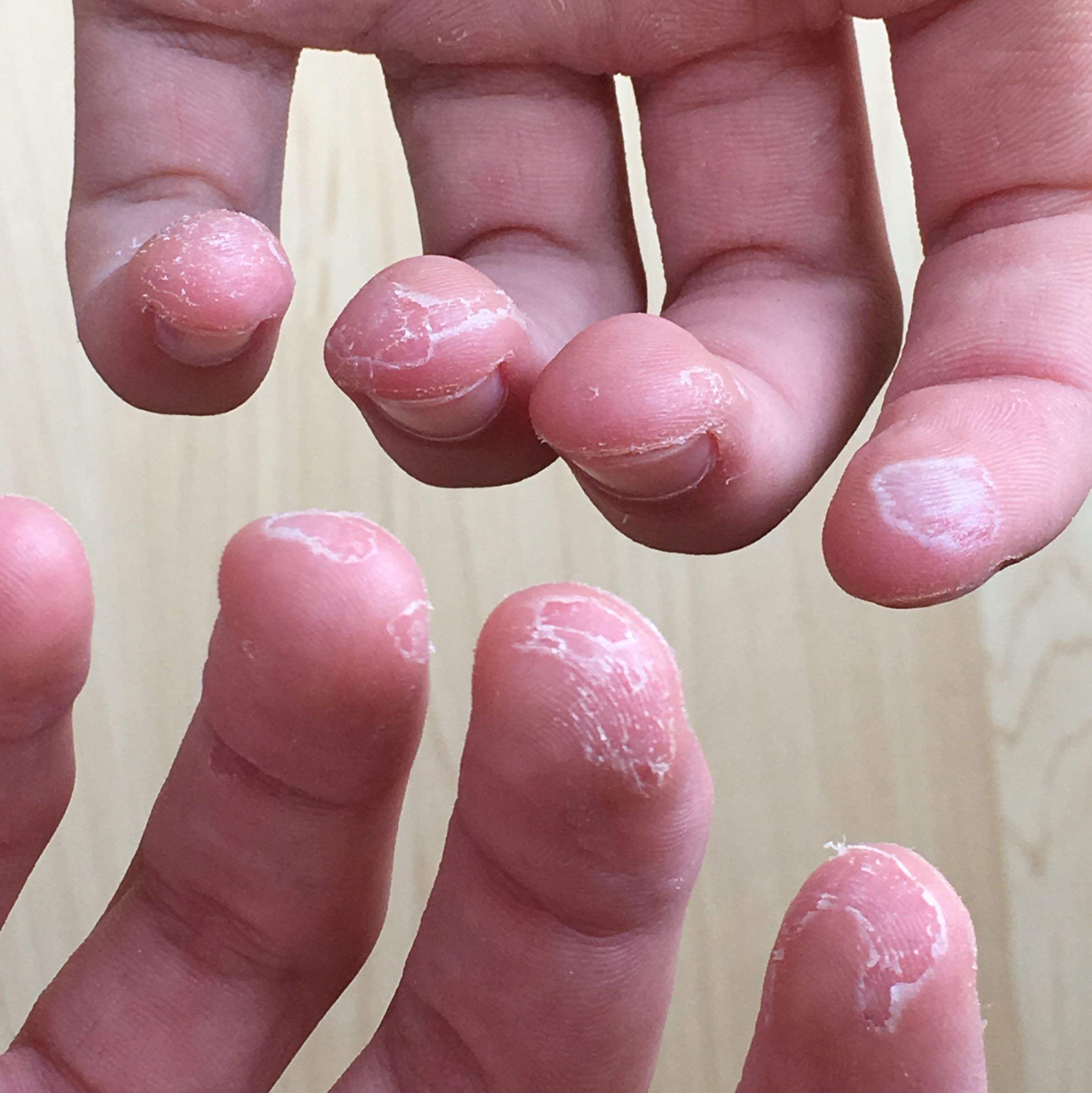Hilfeee! Meine Haut an den Fingerkuppen geht weg? (Arzt, Medikamente, Finger) Hilfeee! Meine Haut an den Fingerkuppen geht weg? (Arzt, Medikamente, Finger)
