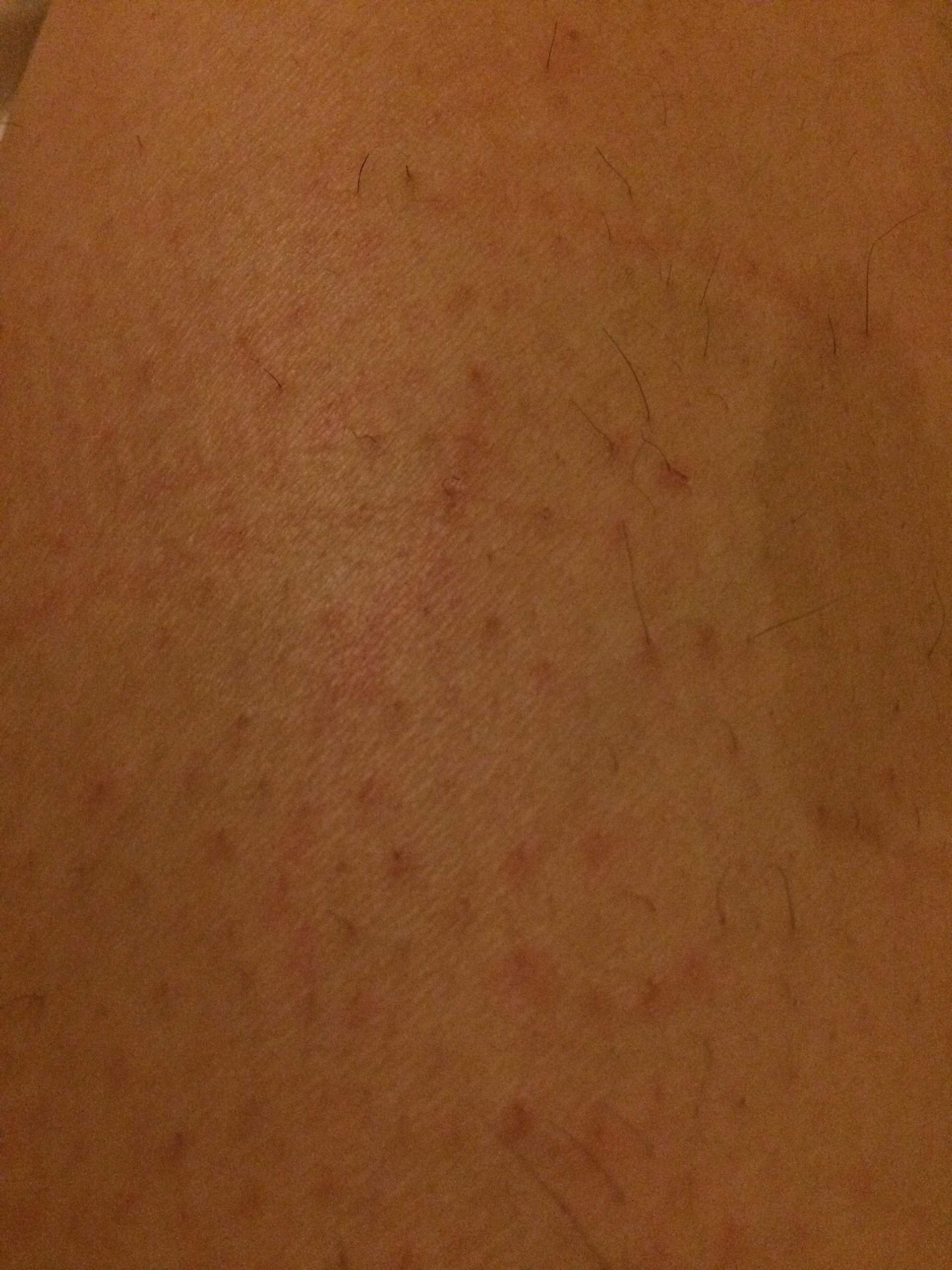 Hilfee HILFEE,Meine Beine schauen mach dem Wachsen schlimm aus? (Enthaarung)