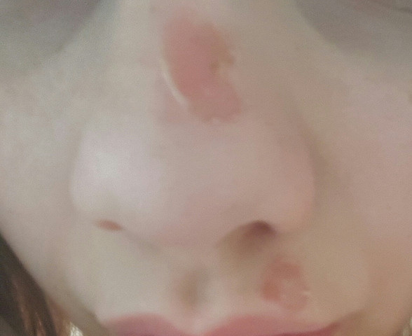 Hilfe Meine Haut Im Gesicht Hautet Sich Hilfe Meine Haut Im Gesicht Hautet Sich