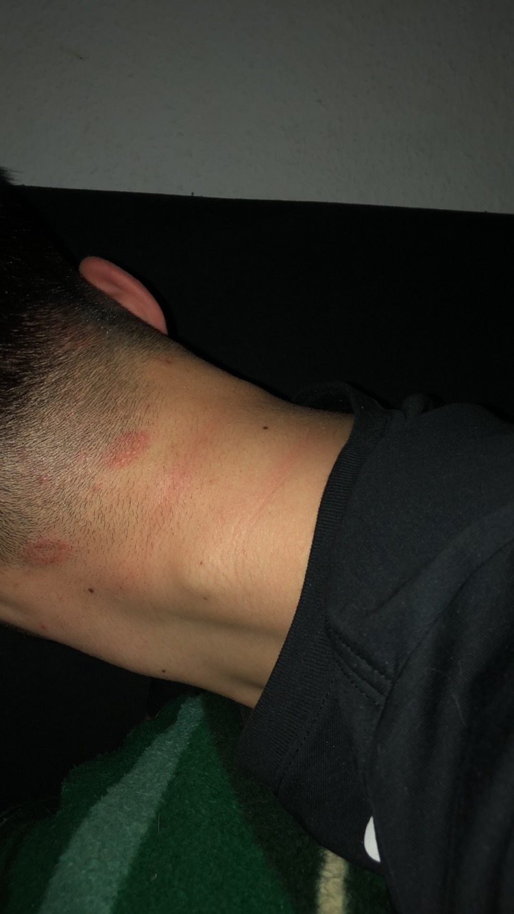 Hilfsmittel Gegen Hautpilz Am Hinterkopf Gesundheit Und Medizin Hautpilzkrankheit Hilfsmittel Gegen Hautpilz Am Hinterkopf Gesundheit Und Medizin Hautpilzkrankheit