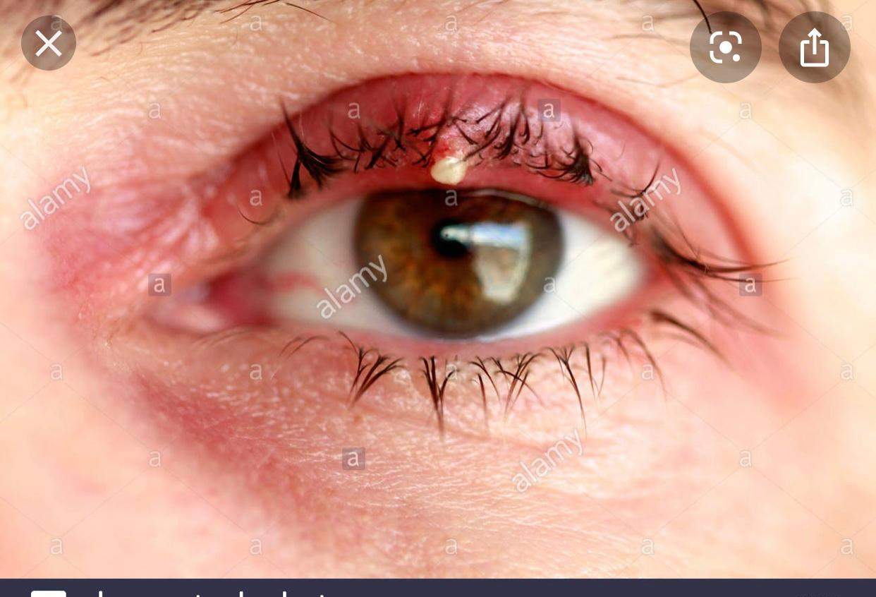 Hilft Die Positiformin 2 Salbe Fur Ein Gersten Korn Auch Wenn Der Gerstenkorn Nicht Direkt Im Auge Sitzt Gesundheit Und Medizin Gesundheit Medizin Hilft Die Positiformin 2 Salbe Fur Ein Gersten Korn Auch Wenn Der Gerstenkorn Nicht Direkt Im Auge Sitzt Gesundheit Und Medizin Gesundheit Medizin