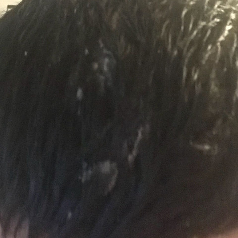 Hilft Eine Glatze Gegen Schuppenflechte Gesundheit Und Medizin Haarausfall Psoriasis Hilft Eine Glatze Gegen Schuppenflechte Gesundheit Und Medizin Haarausfall Psoriasis