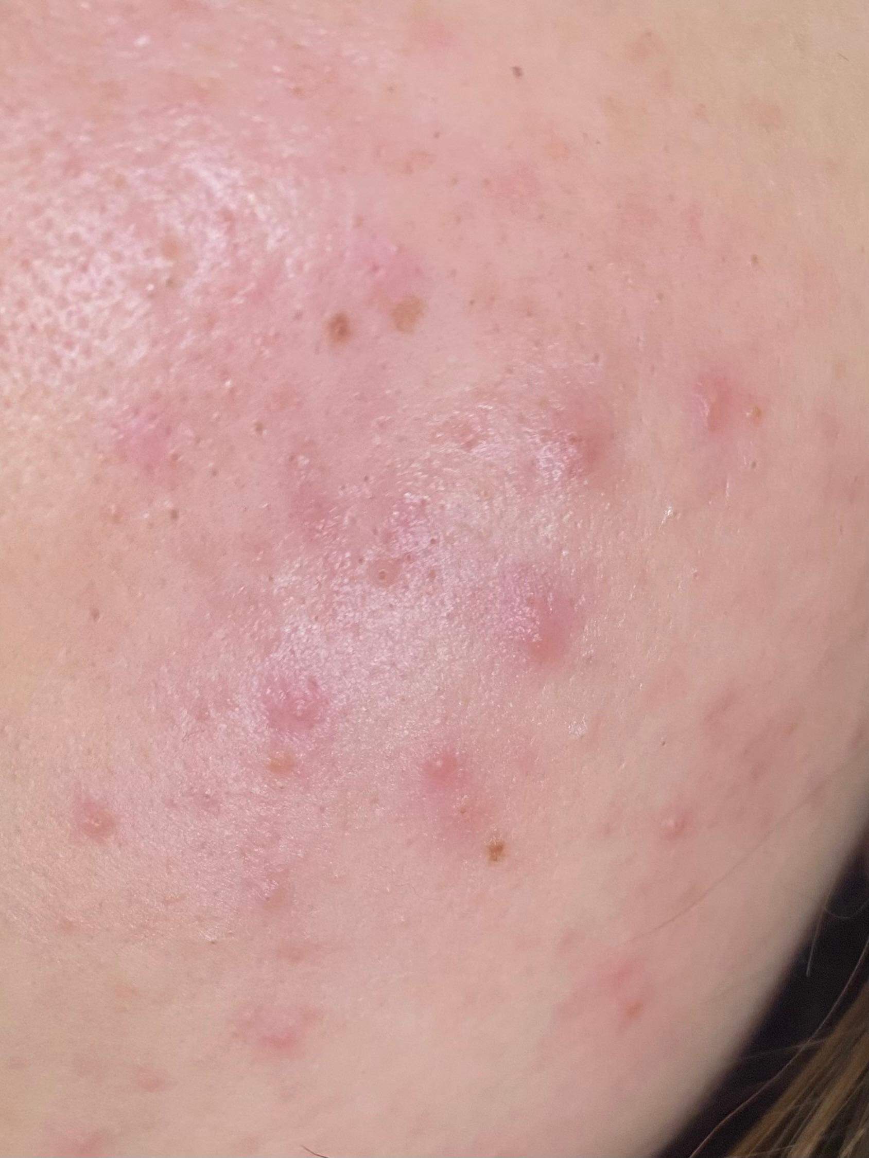 Hilft korean skincare gegen Pickel? Habt ihr gute Produktempehlungen