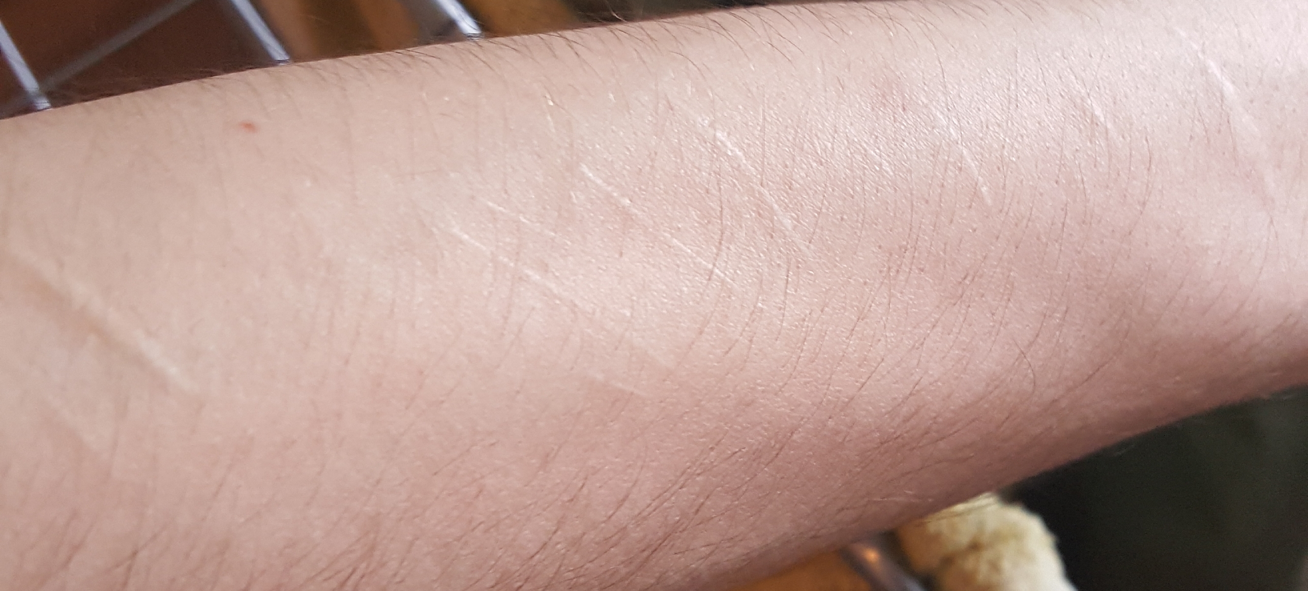 Hilft Laser Gegen Narben Narbenbehandlung Hilft Laser Gegen Narben Narbenbehandlung