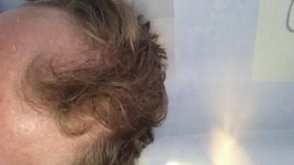 Hilft Regaine Mit 18 Jahren Bei Meinem Starken Haarausfall Bild Gesundheit Und Medizin Gesundheit Medizin