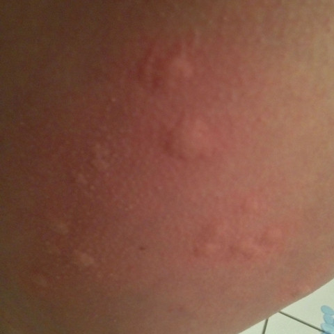 Himmel Was Sind Das Fur Eigenartige Stiche Gesundheit Insekten
