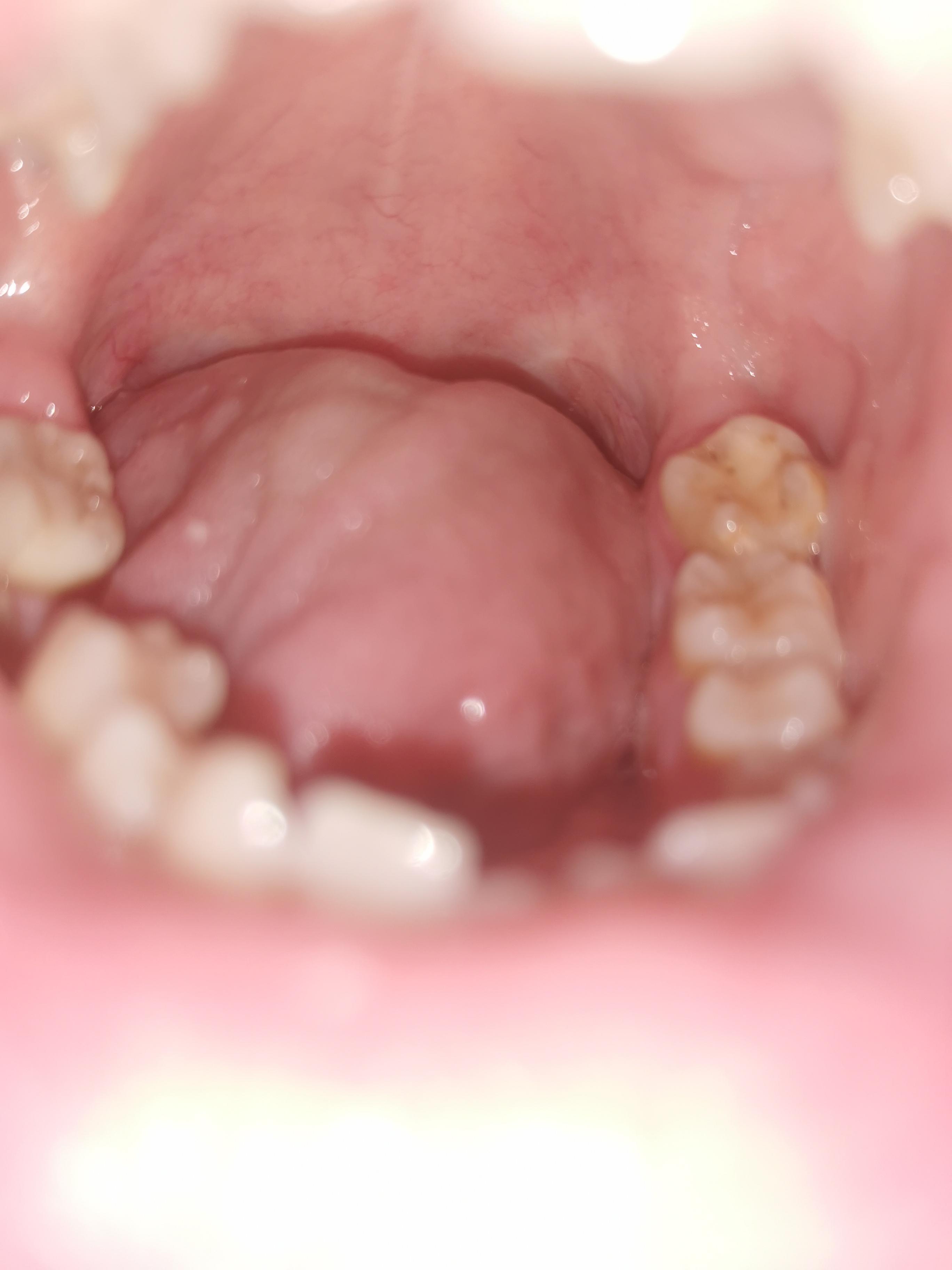 Hinterer Grosser Zahn Tut Weh Zahne Zahnarztbehandlung