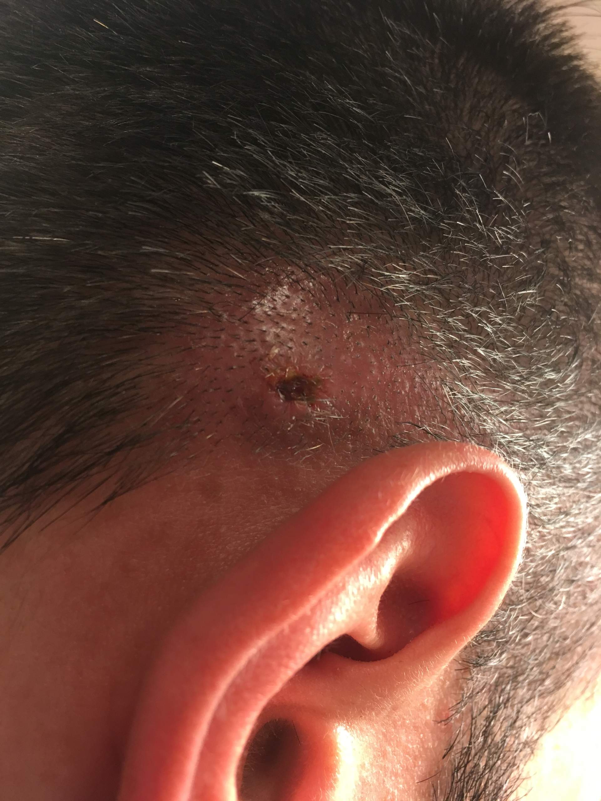 Hinterkopf Pickel/Abszess verursacht Schmerzen? (Gesundheit und Medizin, Gesundheit, Wunde) pickel hinterkopf